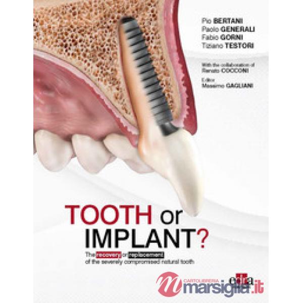 Tooth or Implant? The recovery or replacement of the severely compormised natural tooth