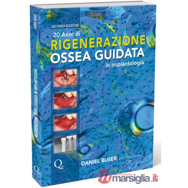 20 anni di rigenerazione ossea guidata in implantologia