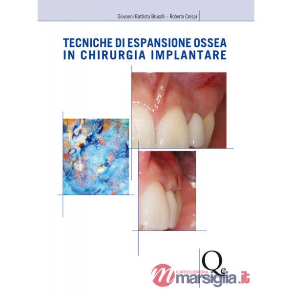 Tecniche di espansione ossea in chirurgia implantare