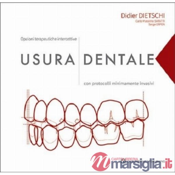 Usura dentale