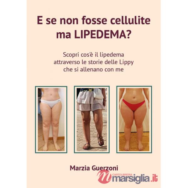 E se non fosse cellulite ma lipedema?